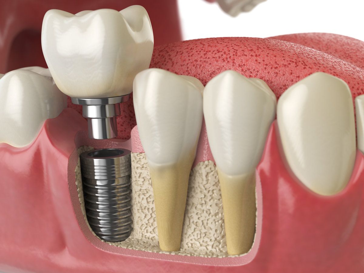 Dental implant illustration with teeth