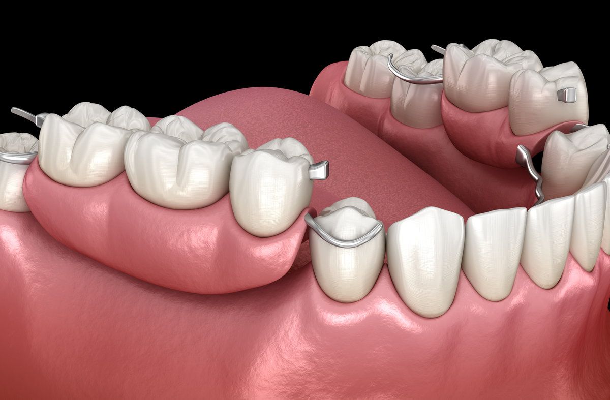 3D rendering of dental braces and teeth