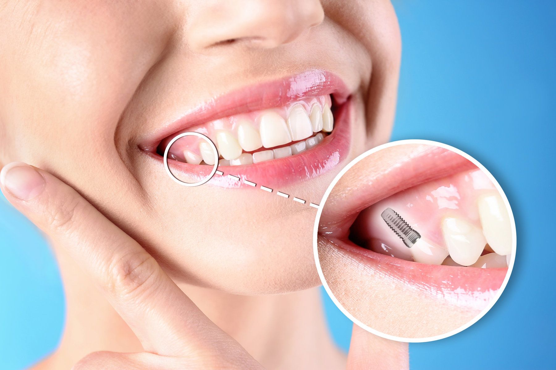 Close-up of smile with dental implant
